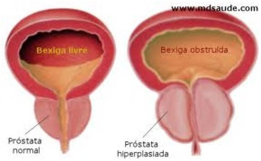 Alimentos nocivos para la prostata